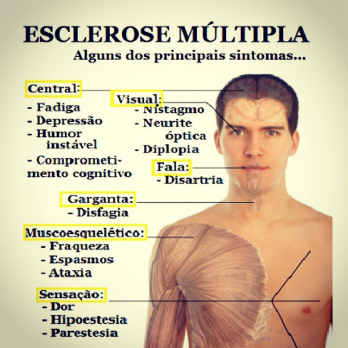 6 sintomas iniciais e surpreendentes da Esclerose Múltipla